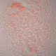 keratosis pilaris - triaderm