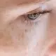 Pigment vlekken op de huid - Traiderm.nl