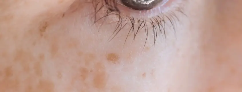 Pigment vlekken op de huid - Traiderm.nl