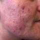 Rosacea en overbeharing elektrische epilatie