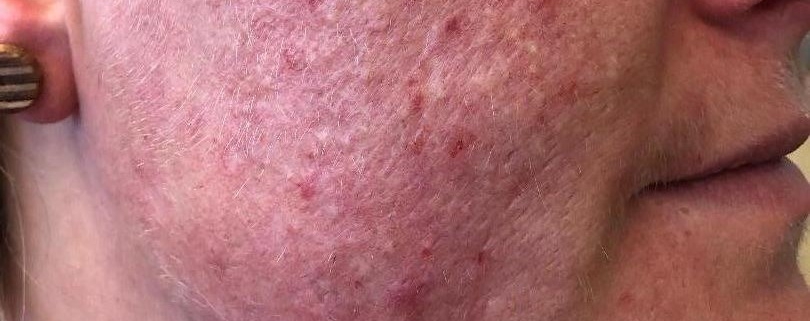 Rosacea en overbeharing elektrische epilatie