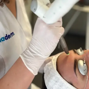 Laserpeel