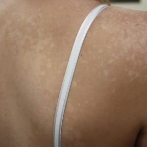 Pytiriasis Versicolor afbeelding