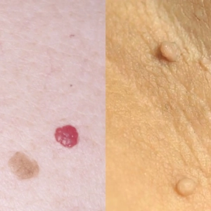 angiomen en fibromen