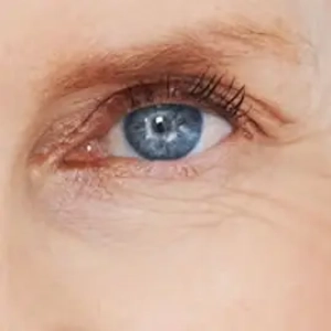 fotona-smootheye-270-min